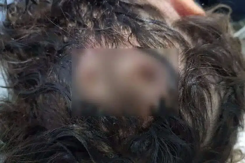Menina vítima de maus-tratos internada com larvas de mosca na cabeça