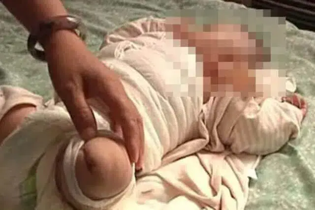 Bebê tem a perna amputada após enfermeira queimá-la com secador