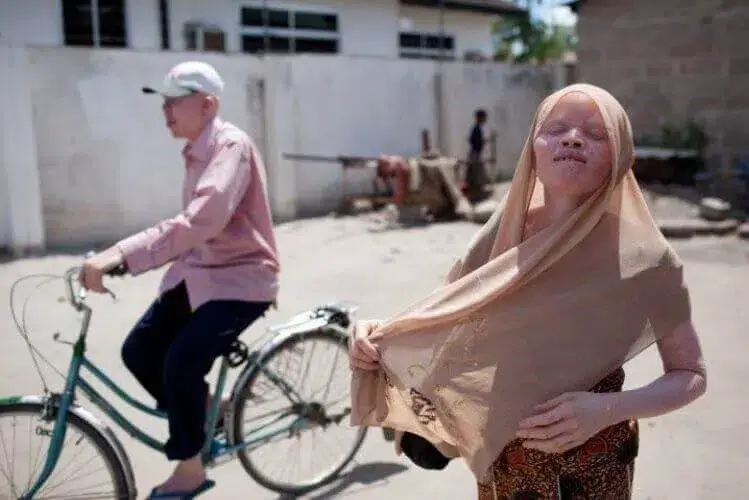 Governo reitera apoio social aos albinos