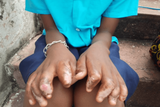 Tio agride e mutila sobrinha de 8 anos em Nampula