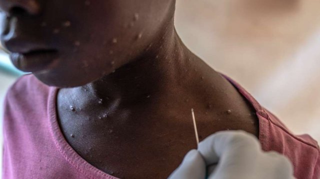 Niassa regista aumento de casos de 'Mpox'