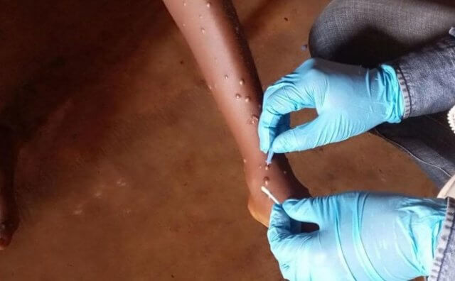 Governo de Moçambique reforça medidas contra o alastramento da Mpox