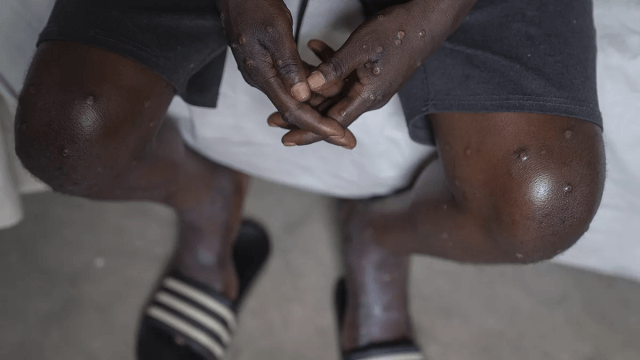 Niassa regista quatro novos casos de Mpox, totalizando 38 infecções