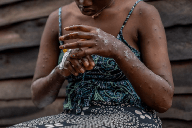 Tete regista primeiro caso positivo de Mpox
