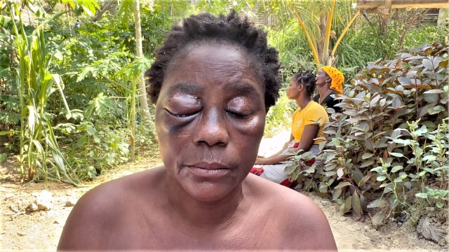 Mulher perde olho após agressão brutal em Pemba